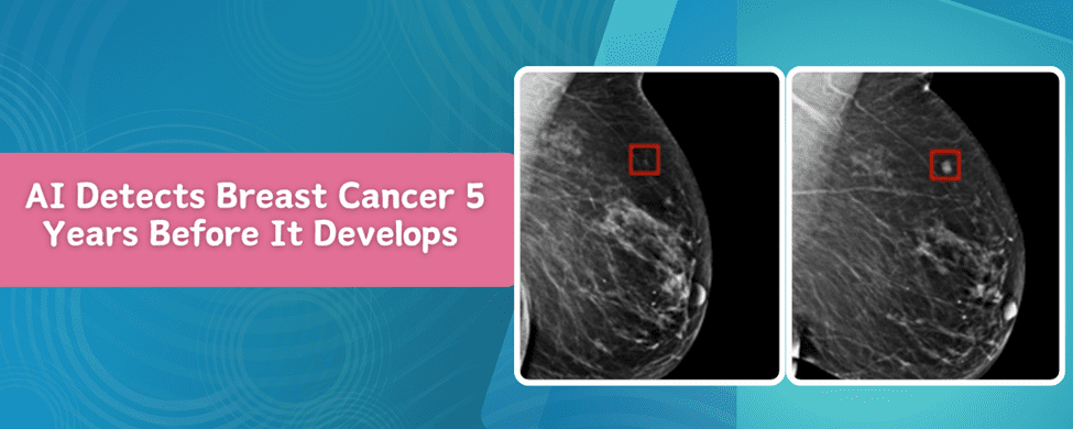 AI Detects Breast Cancer 5 years before it develops with two images side by side showing the start of cancer and how it progresses on imaging.